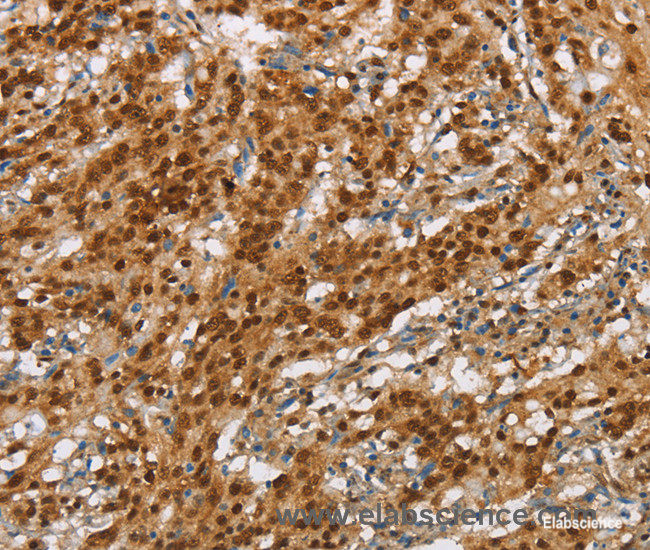 Immunohistochemistry of paraffin-embedded Human gasrtic cancer tissue using NLRP7 Polyclonal Antibody at dilution 1:60
