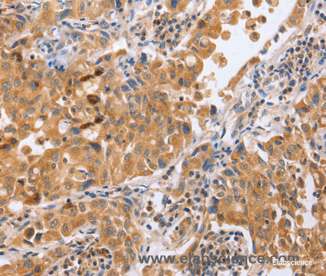 Immunohistochemistry of paraffin-embedded Human lung cancer tissue using BLNK Polyclonal Antibody at dilution 1:50