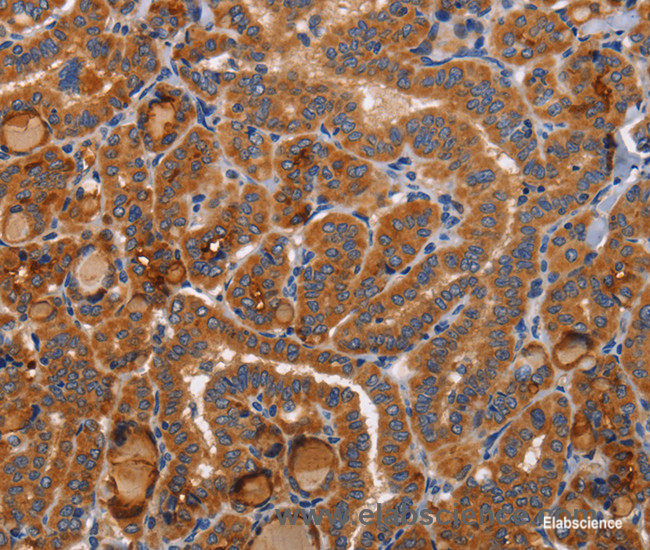 Immunohistochemistry of paraffin-embedded Human thyroid cancer tissue using BMP6 Polyclonal Antibody at dilution 1:40
