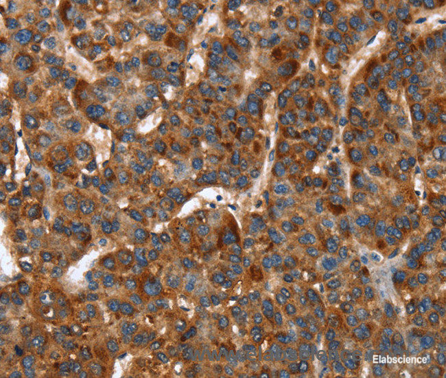 Immunohistochemistry of paraffin-embedded Human liver cancer tissue using CACNB2 Polyclonal Antibody at dilution 1:30