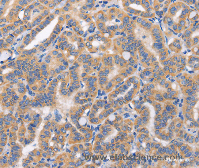 Immunohistochemistry of paraffin-embedded Human thyroid cancer tissue using CARD17 Polyclonal Antibody at dilution 1:50