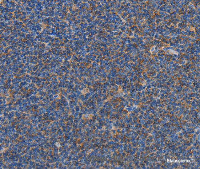 Immunohistochemistry of paraffin-embedded Human Lymphoma tissue using CARD6 Polyclonal Antibody at dilution 1:60