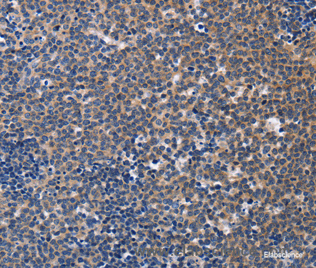 Immunohistochemistry of paraffin-embedded Human Lymphoma tissue using CCR6 Polyclonal Antibody at dilution 1:50
