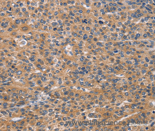 Immunohistochemistry of paraffin-embedded Human liver cancer tissue using NCR2 Polyclonal Antibody at dilution 1:60