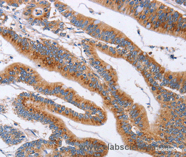 Immunohistochemistry of paraffin-embedded Human colon cancer tissue using CD327 Polyclonal Antibody at dilution 1:60