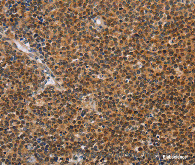 Immunohistochemistry of paraffin-embedded Human Lymphoma tissue using CD36 Polyclonal Antibody at dilution 1:60