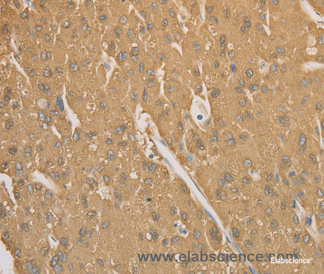 Immunohistochemistry of paraffin-embedded Human liver cancer tissue using CD40 Polyclonal Antibody at dilution 1:70