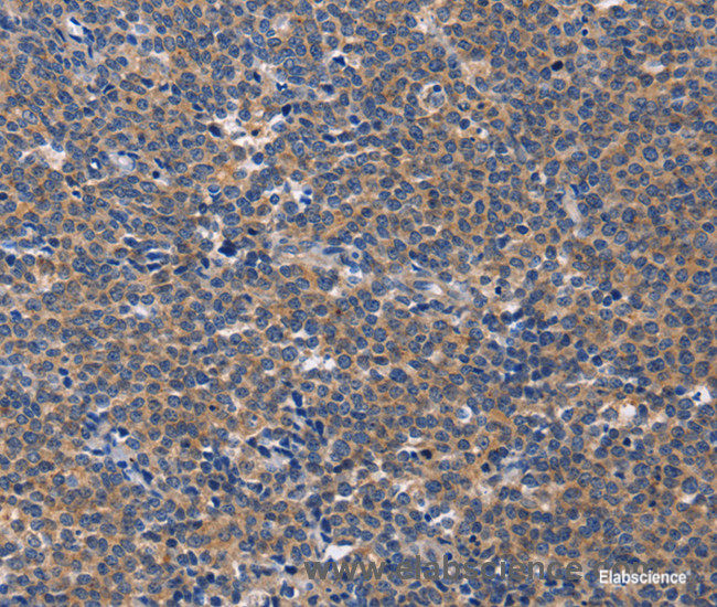 Immunohistochemistry of paraffin-embedded Human Lymphoma tissue using CD5L Polyclonal Antibody at dilution 1:40