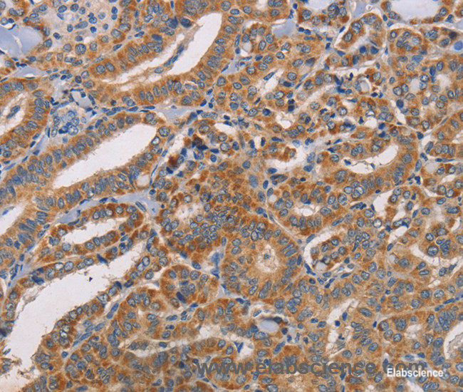 Immunohistochemistry of paraffin-embedded Human thyroid cancer tissue using CDK11A/B Polyclonal Antibody at dilution 1:50