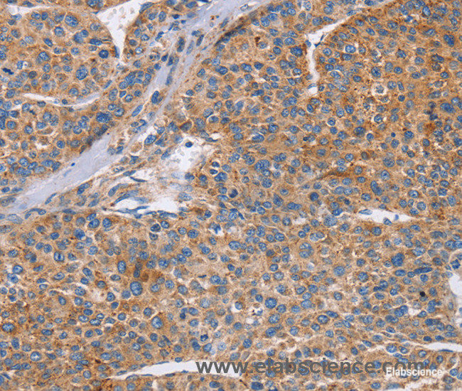 Immunohistochemistry of paraffin-embedded Human liver cancer tissue using CDC7 Polyclonal Antibody at dilution 1:70