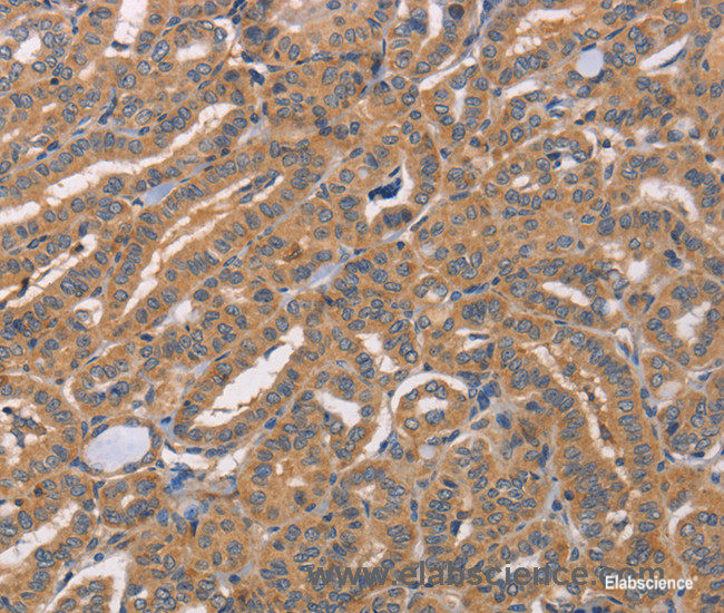 Immunohistochemistry of paraffin-embedded Human thyroid cancer tissue using CDCA4 Polyclonal Antibody at dilution 1:50