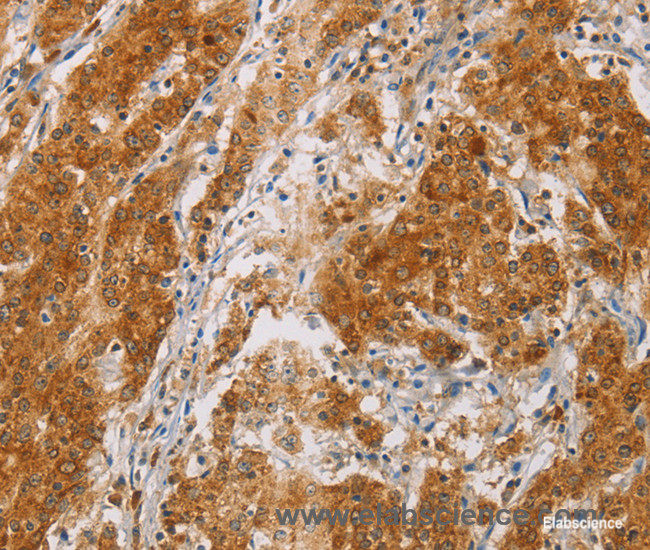 Immunohistochemistry of paraffin-embedded Human gasrtic cancer tissue using CENPE Polyclonal Antibody at dilution 1:50
