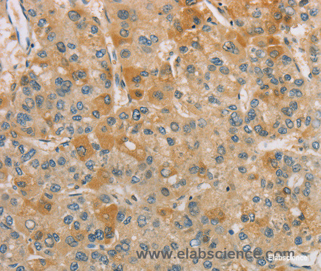 Immunohistochemistry of paraffin-embedded Human liver cancer tissue using CENPF Polyclonal Antibody at dilution 1:40