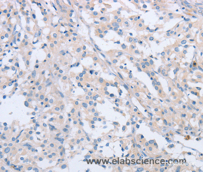Immunohistochemistry of paraffin-embedded Human thyroid cancer tissue using AGAP2 Polyclonal Antibody at dilution 1:60