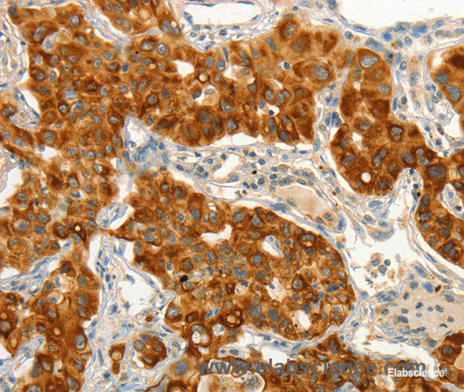 Immunohistochemistry of paraffin-embedded Human lung cancer tissue using CIB1 Polyclonal Antibody at dilution 1:50