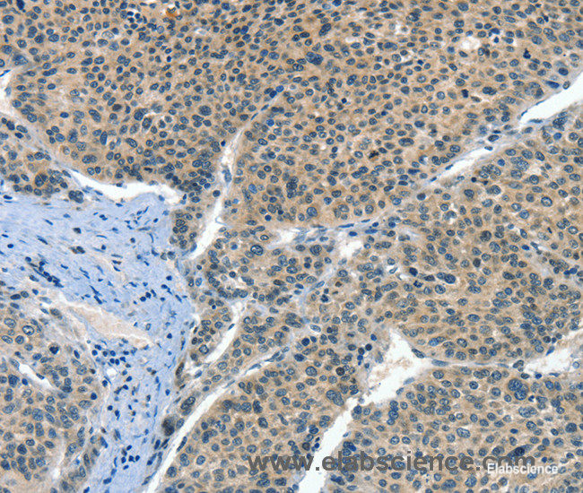 Immunohistochemistry of paraffin-embedded Human liver cancer tissue using CRLF2 Polyclonal Antibody at dilution 1:60