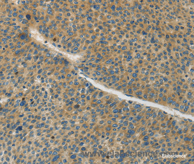 Immunohistochemistry of paraffin-embedded Human liver cancer tissue using Connexin-45 Polyclonal Antibody at dilution 1:50