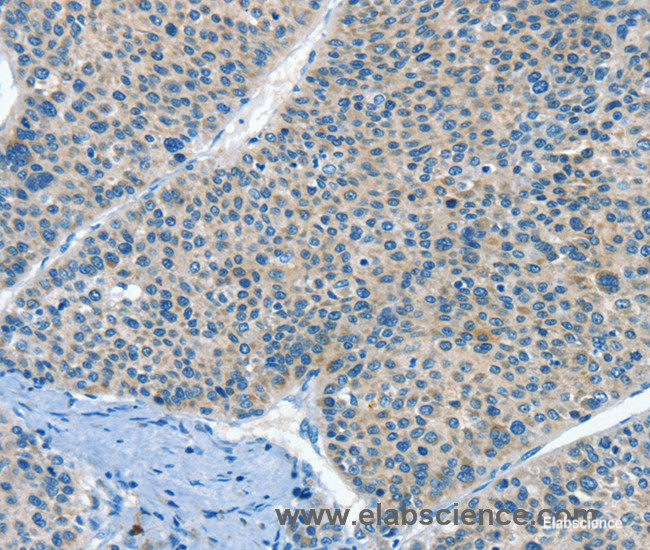 Immunohistochemistry of paraffin-embedded Human liver cancer tissue using HID1 Polyclonal Antibody at dilution 1:50