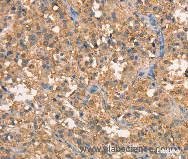 Immunohistochemistry of paraffin-embedded Human thyroid cancer tissue using CRELD1 Polyclonal Antibody at dilution 1:40