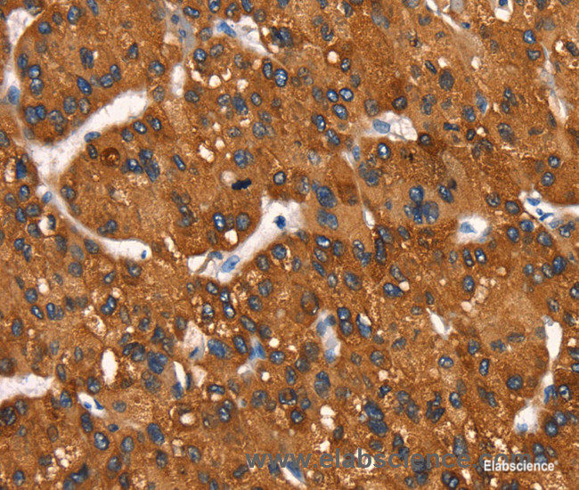 Immunohistochemistry of paraffin-embedded Human liver cancer tissue using Cytochrome b Polyclonal Antibody at dilution 1:50