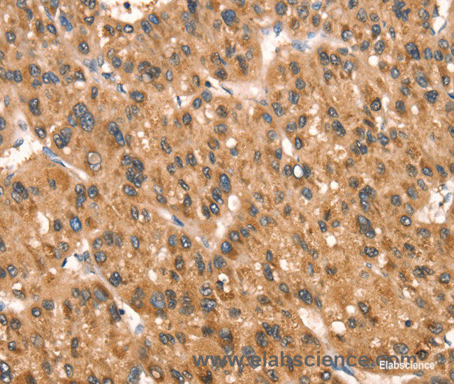 Immunohistochemistry of paraffin-embedded Human liver cancer tissue using DAP Polyclonal Antibody at dilution 1:40