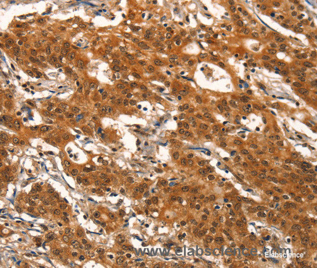 Immunohistochemistry of paraffin-embedded Human gasrtic cancer tissue using DEAF1 Polyclonal Antibody at dilution 1:40