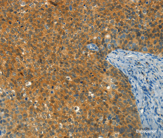 Immunohistochemistry of paraffin-embedded Human cervical cancer tissue using DIRAS1 Polyclonal Antibody at dilution 1:30