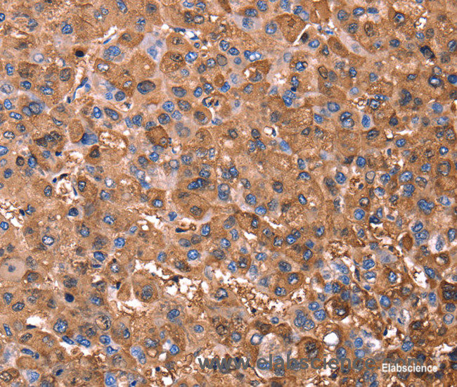 Immunohistochemistry of paraffin-embedded Human liver cancer tissue using ERN2 Polyclonal Antibody at dilution 1:40