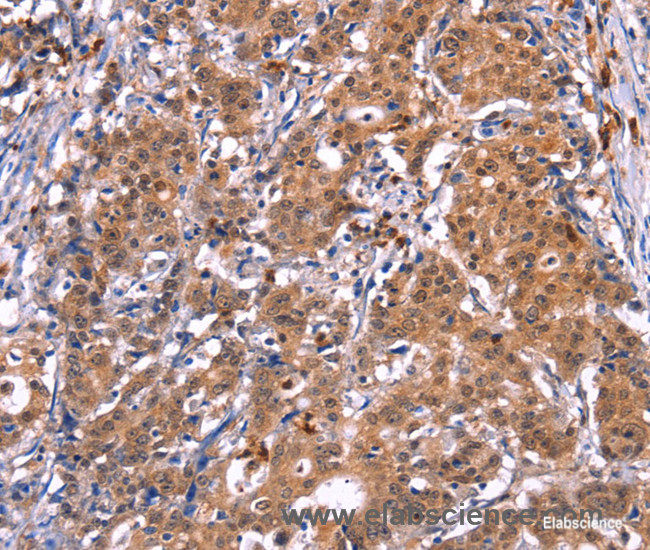 Immunohistochemistry of paraffin-embedded Human gasrtic cancer tissue using GCG Polyclonal Antibody at dilution 1:40