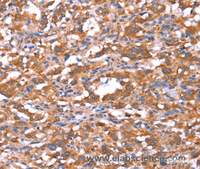 Immunohistochemistry of paraffin-embedded Human thyroid cancer tissue using FAM13B Polyclonal Antibody at dilution 1:30