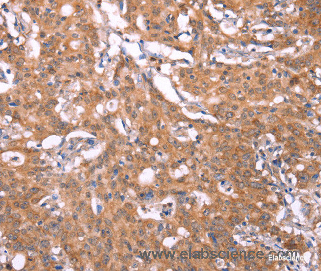 Immunohistochemistry of paraffin-embedded Human gasrtic cancer tissue using FBXO31 Polyclonal Antibody at dilution 1:40