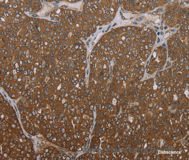 Immunohistochemistry of paraffin-embedded Human ovarian cancer tissue using FOLH1B Polyclonal Antibody at dilution 1:30