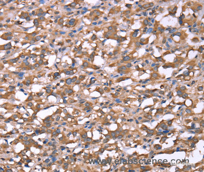 Immunohistochemistry of paraffin-embedded Human thyroid cancer tissue using SPAST Polyclonal Antibody at dilution 1:40