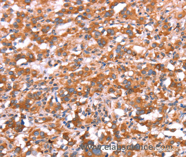Immunohistochemistry of paraffin-embedded Human thyroid cancer tissue using GAS8 Polyclonal Antibody at dilution 1:30