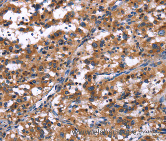 Immunohistochemistry of paraffin-embedded Human thyroid cancer tissue using R3HCC1L Polyclonal Antibody at dilution 1:40