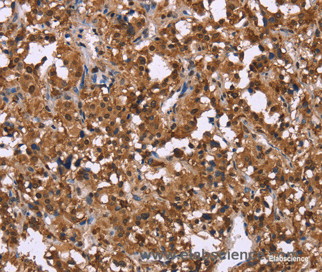 Immunohistochemistry of paraffin-embedded Human thyroid cancer tissue using GPR171 Polyclonal Antibody at dilution 1:40