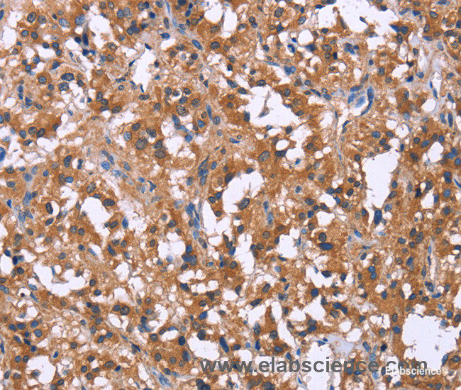 Immunohistochemistry of paraffin-embedded Human thyroid cancer tissue using GPR172B Polyclonal Antibody at dilution 1:40