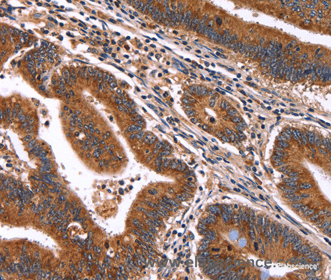 Immunohistochemistry of paraffin-embedded Human colon cancer tissue using HACE1 Polyclonal Antibody at dilution 1:50