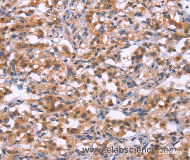 Immunohistochemistry of paraffin-embedded Human thyroid cancer tissue using BRK1 Polyclonal Antibody at dilution 1:30