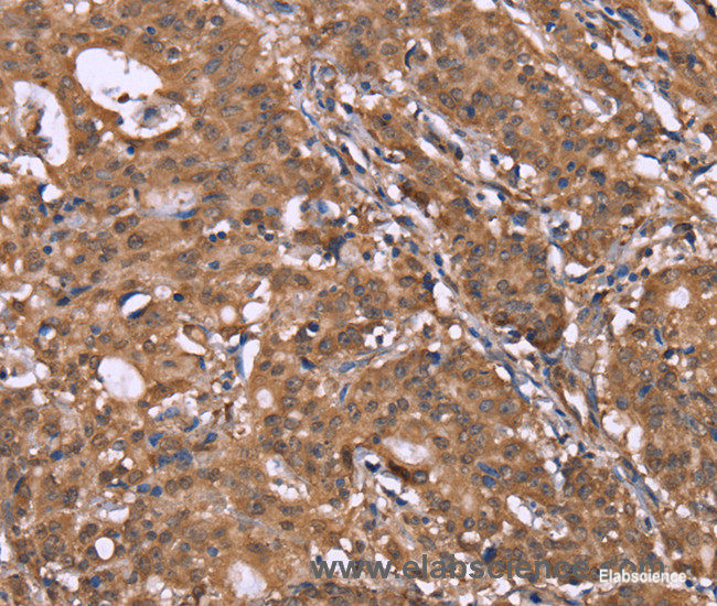 Immunohistochemistry of paraffin-embedded Human gasrtic cancer tissue using HLTF Polyclonal Antibody at dilution 1:40