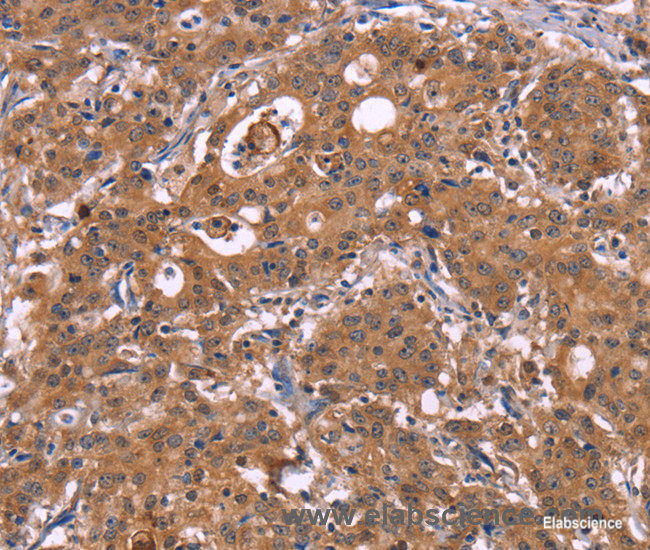 Immunohistochemistry of paraffin-embedded Human gasrtic cancer tissue using HMGCS1 Polyclonal Antibody at dilution 1:40