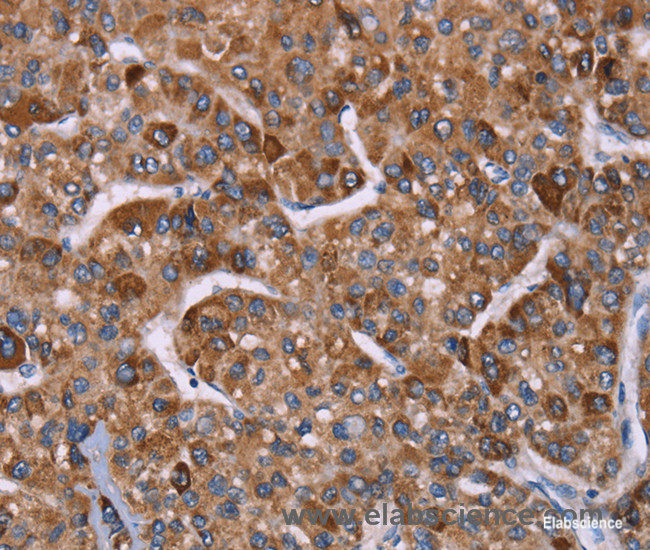 Immunohistochemistry of paraffin-embedded Human liver cancer tissue using HSP10 Polyclonal Antibody at dilution 1:40