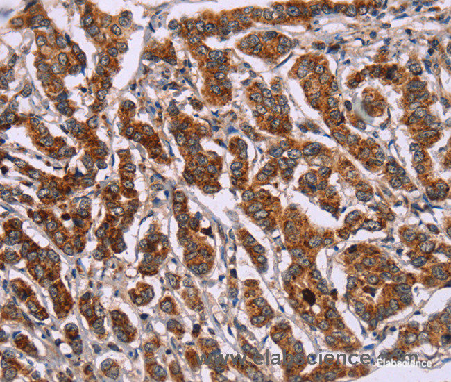 Immunohistochemistry of paraffin-embedded Human breast cancer tissue using ID2 Polyclonal Antibody at dilution 1:30