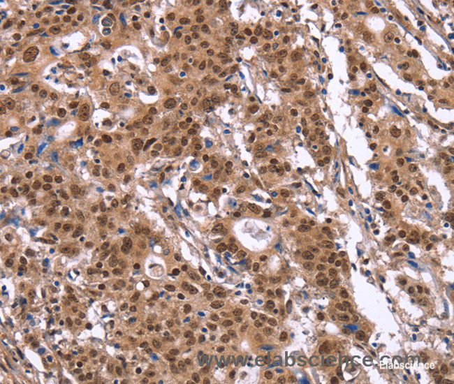 Immunohistochemistry of paraffin-embedded Human gasrtic cancer tissue using ID4 Polyclonal Antibody at dilution 1:40