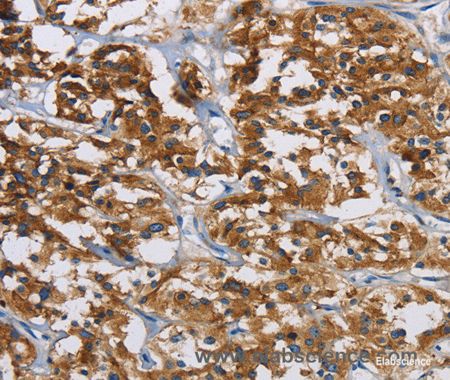 Immunohistochemistry of paraffin-embedded Human thyroid cancer tissue using IGF2R Polyclonal Antibody at dilution 1:40