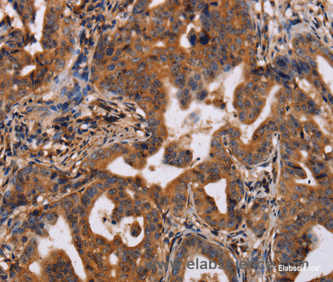 Immunohistochemistry of paraffin-embedded Human gasrtic cancer tissue using IL12RB2 Polyclonal Antibody at dilution 1:40