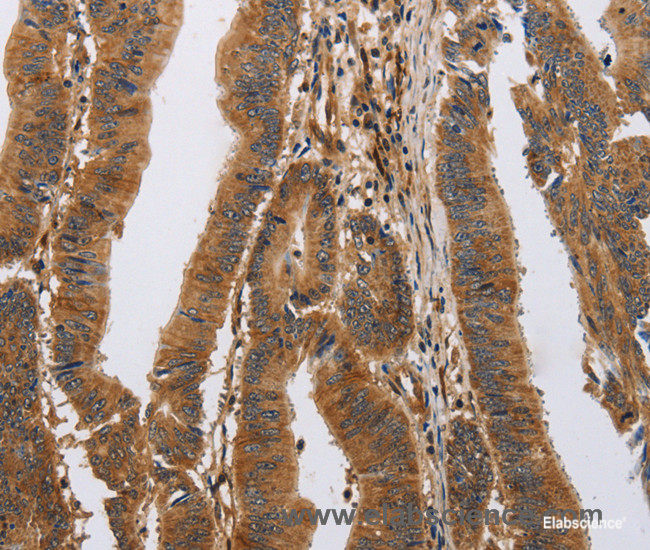 Immunohistochemistry of paraffin-embedded Human colon cancer tissue using ITPR1 Polyclonal Antibody at dilution 1:40
