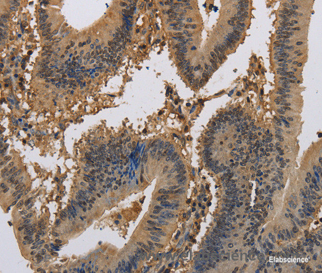 Immunohistochemistry of paraffin-embedded Human colon cancer tissue using KCNA7 Polyclonal Antibody at dilution 1:40