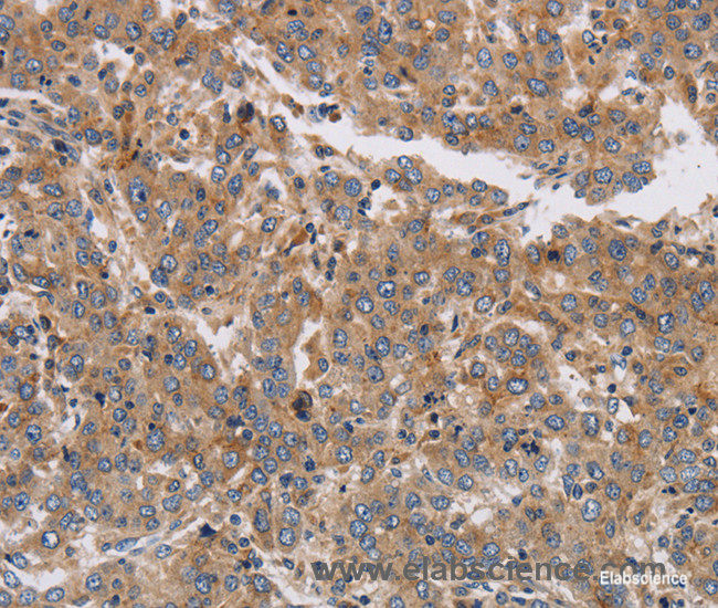 Immunohistochemistry of paraffin-embedded Human liver cancer tissue using KCNG1 Polyclonal Antibody at dilution 1:40
