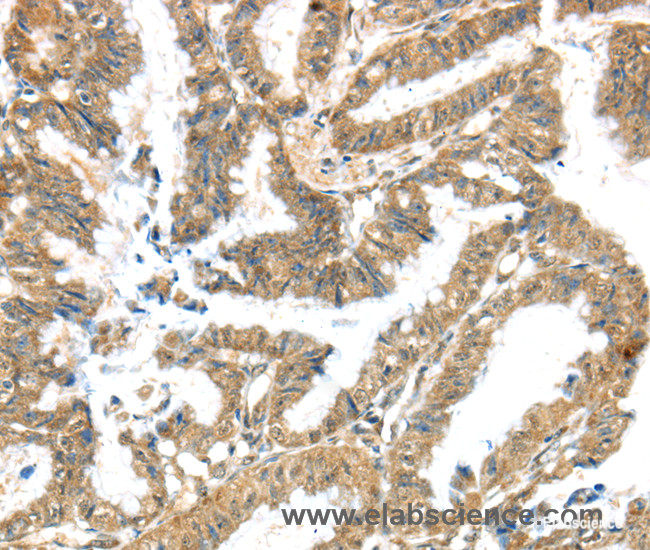 Immunohistochemistry of paraffin-embedded Human colon cancer tissue using KCNG3 Polyclonal Antibody at dilution 1:40